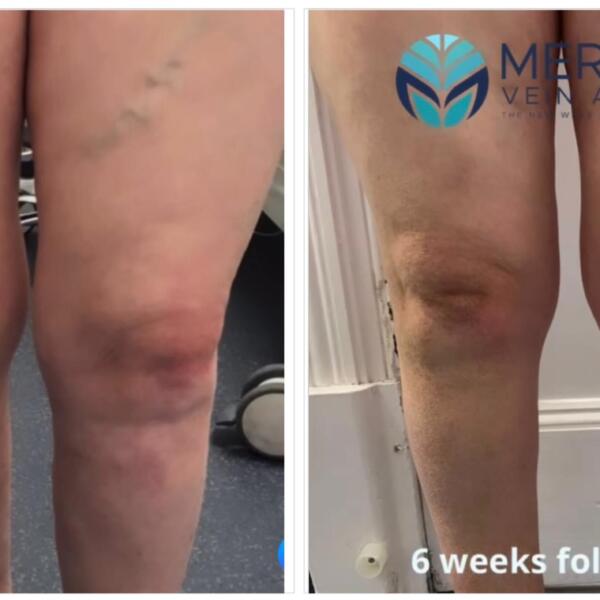 Varicose Veins