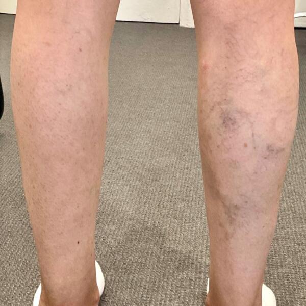Veins