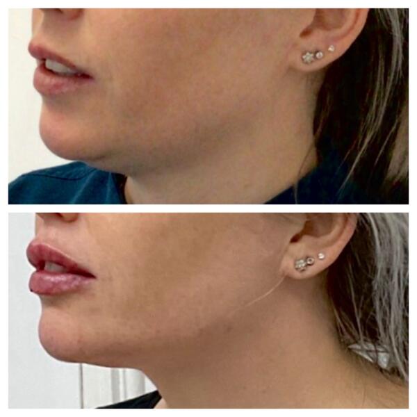 Jaw And Lip Filler (1)
