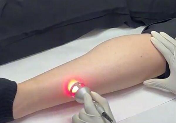 Photobiomodulating light treatment