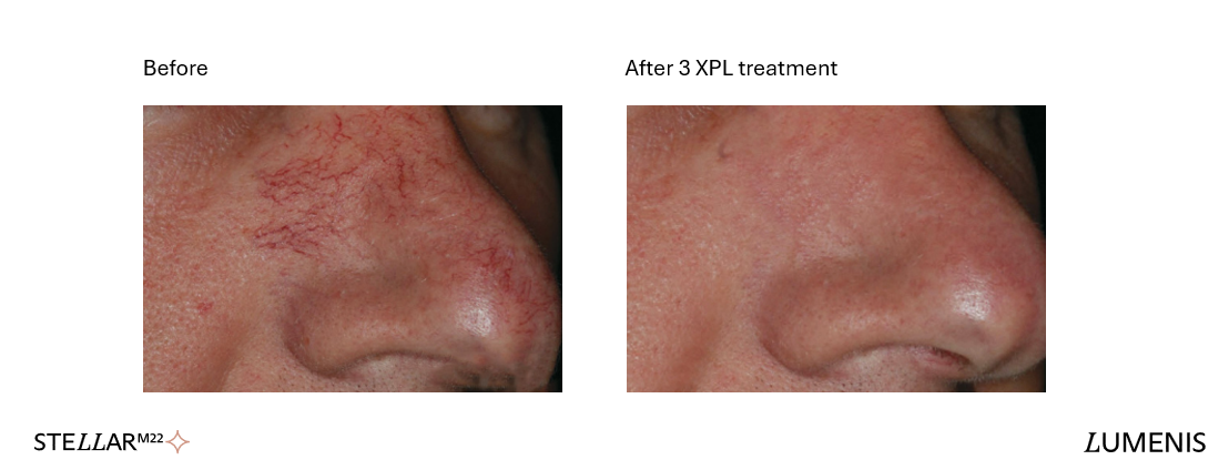 Before and after photos of facial redness and broken capillaries around the nose showing reduced visible veins after 3 XPL treatments